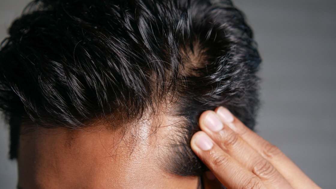 The Role of Scalp Microbiome on Hair Loss