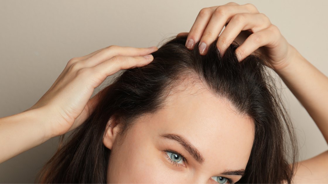 Top 4 Ways to Naturally Banish Dry, Flaky, Itchy Scalp