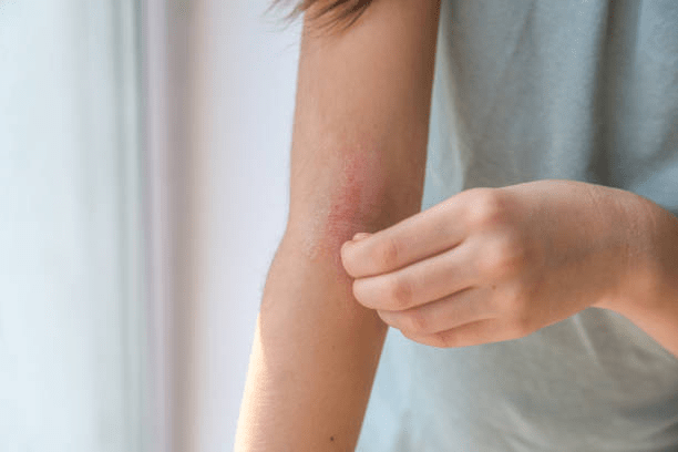 Top 10 Myths About Eczema and Psoriasis Debunked