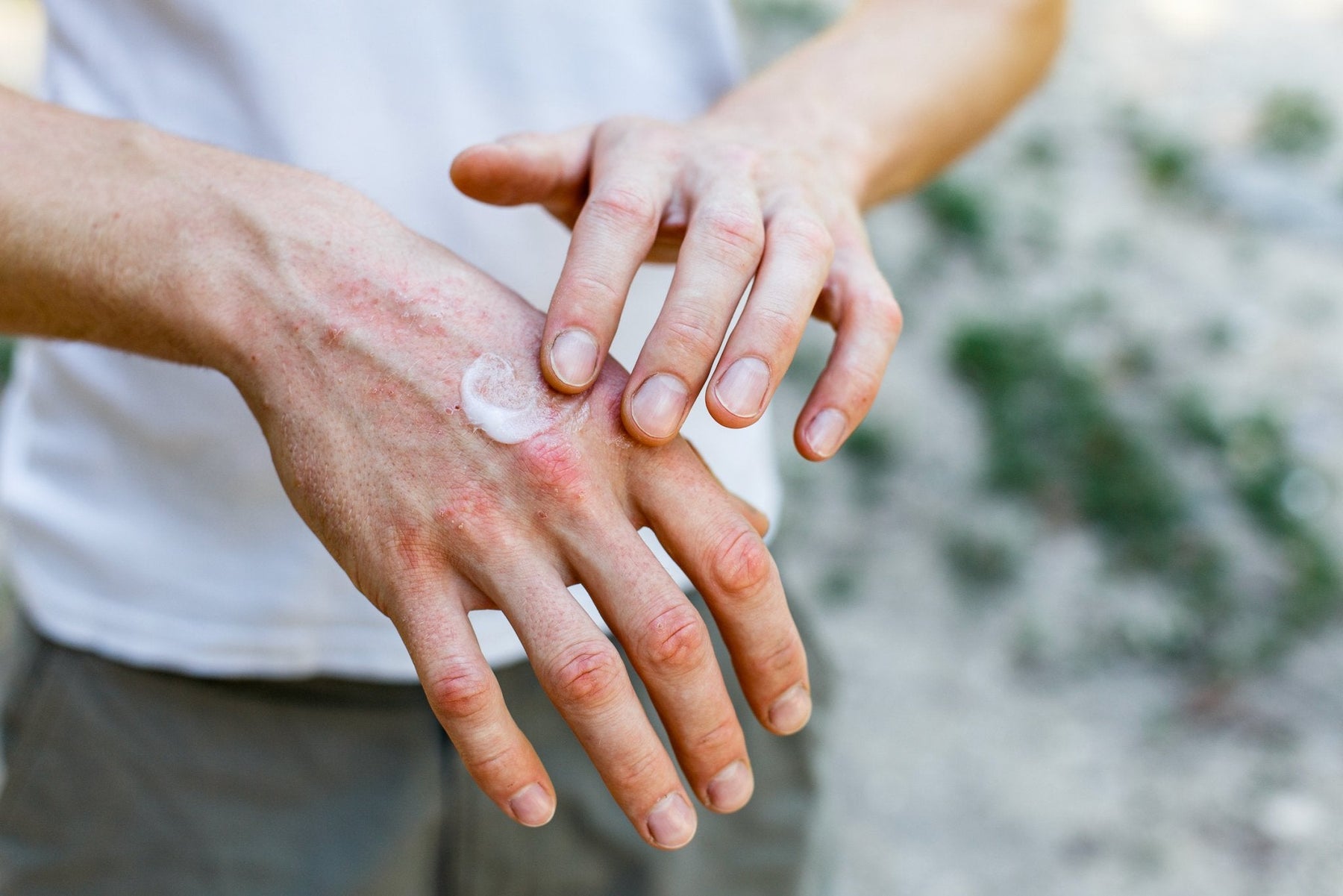 Eczema vs Psoriasis - What’s the Difference?