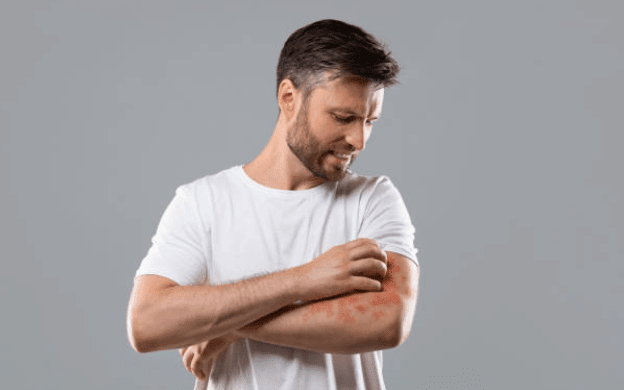 Five Pillars of Eczema: Causes, Triggers, Symptoms, and How to Control Flare-Ups