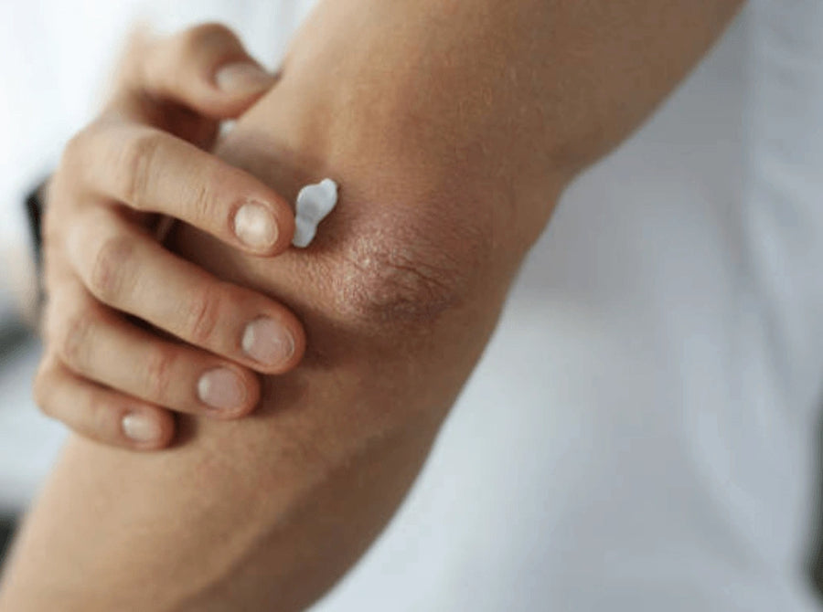 Psoriasis Prone Skin