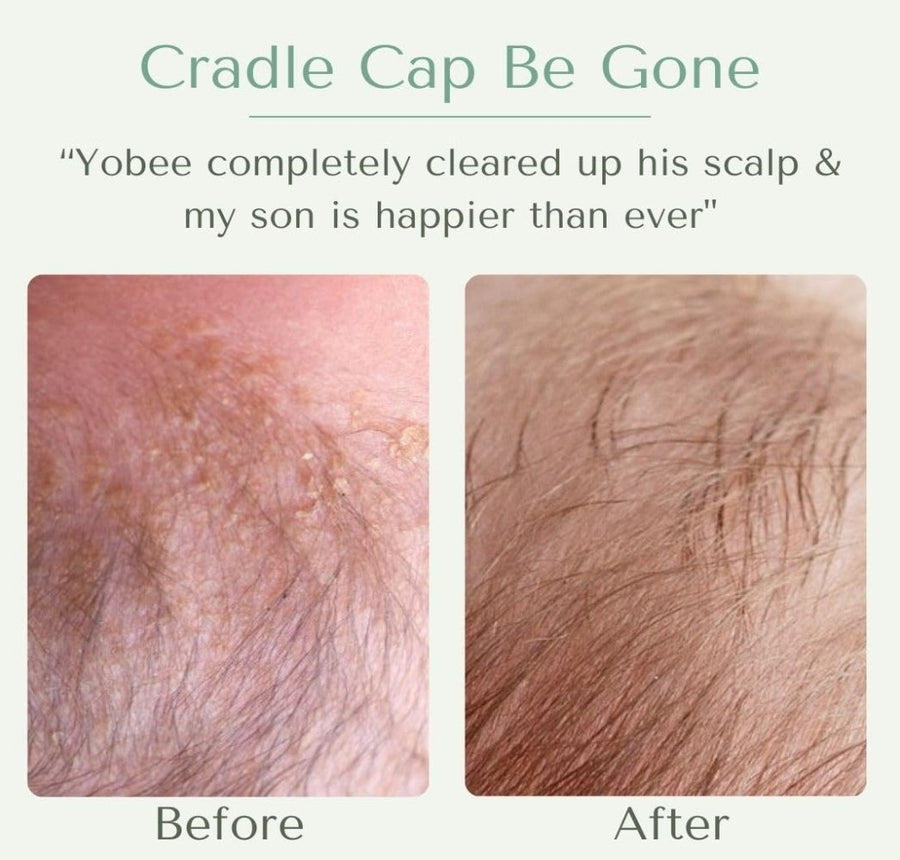 Scalp Hair Mask for Babies cradle cap eczema flakes dandruff dermatitis